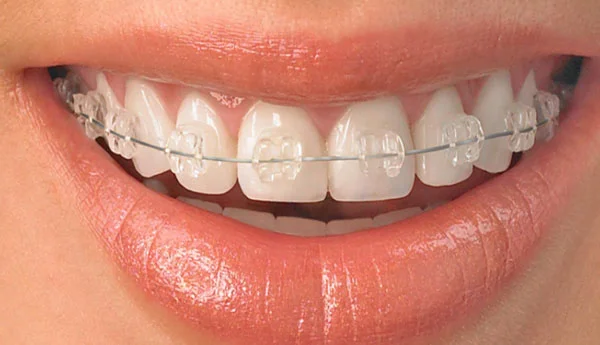 Aparat dentar ceramic