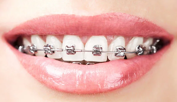 Aparat dentar fix metalic