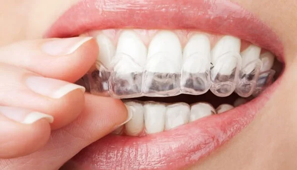 Aparat dentar Invisalign