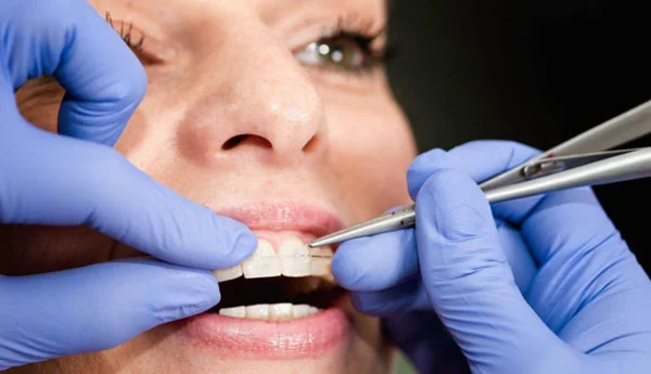 Aparat dentar Safir