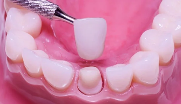 Coroane dentare