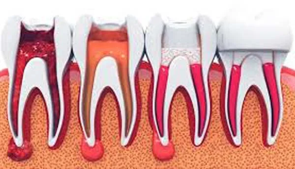 Endodonție
