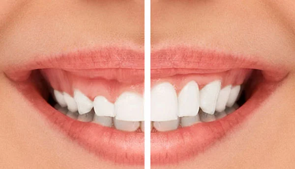Gingivectomie și gingivoplastie