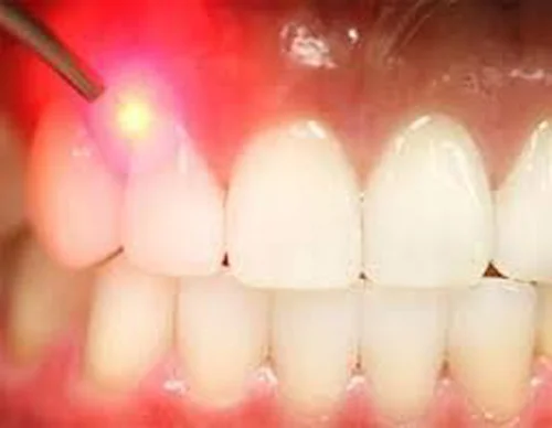 Laserul dentar