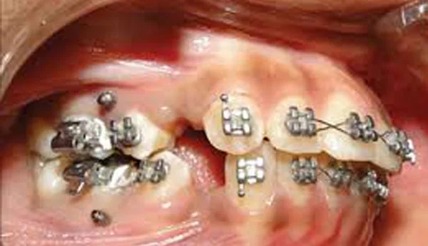 Mini-implanturi ortodontice