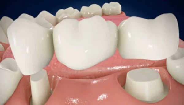 Protetică dentară